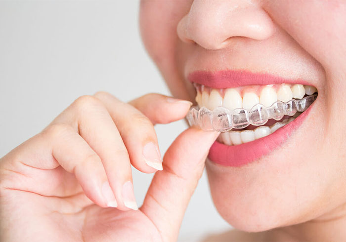 ΔΙΑΦΑΝΕΙΣ ΝΑΡΘΗΚΕΣ INVISALIGN